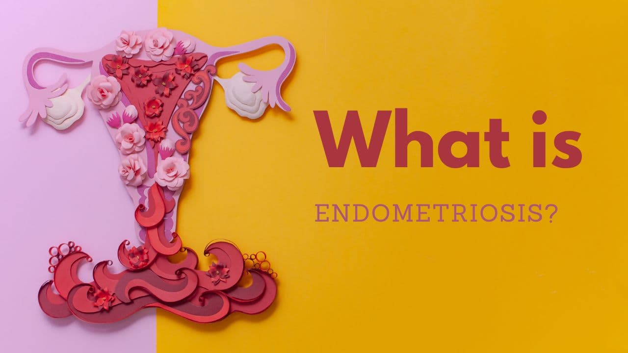 What is Endometriosis Educational illustration explaining what endometriosis is